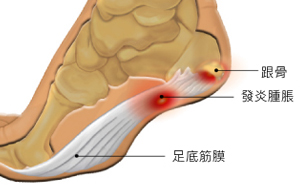 足底筋膜炎鞋款